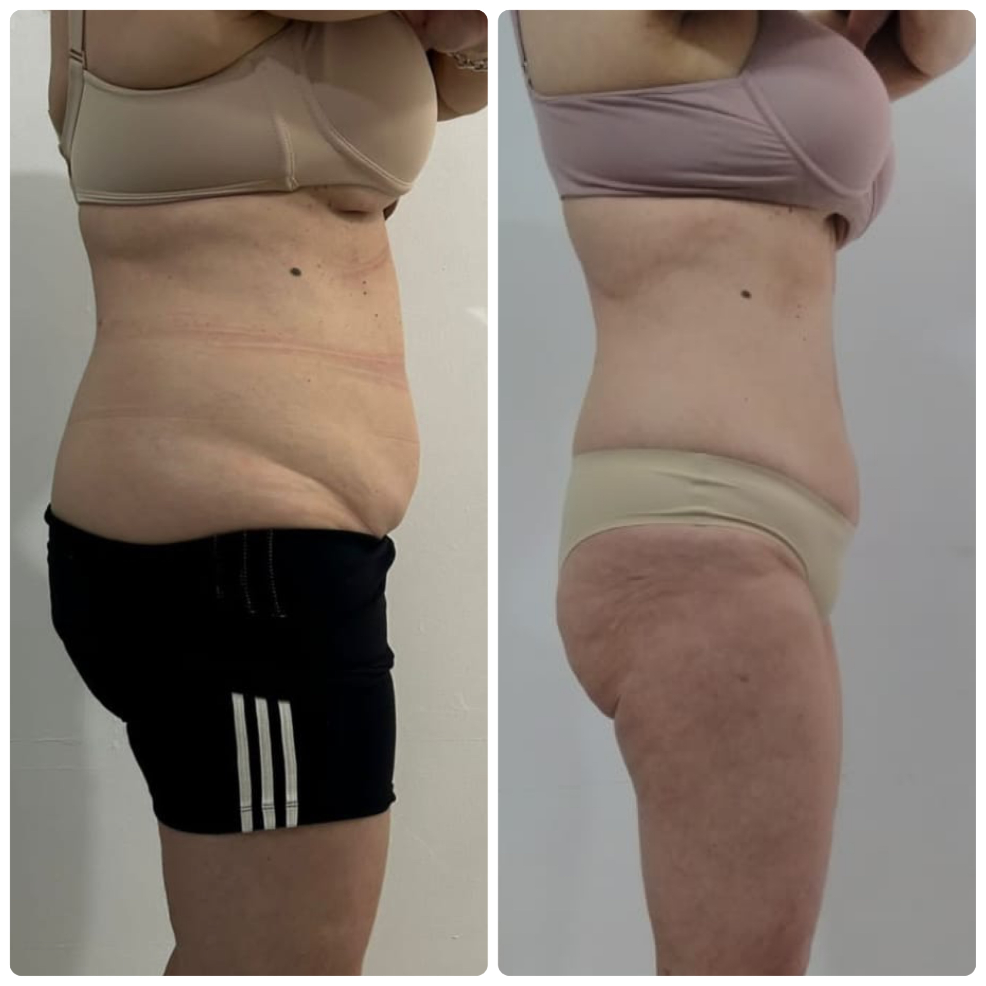 Antes e depois — Definição de cintura e quadril