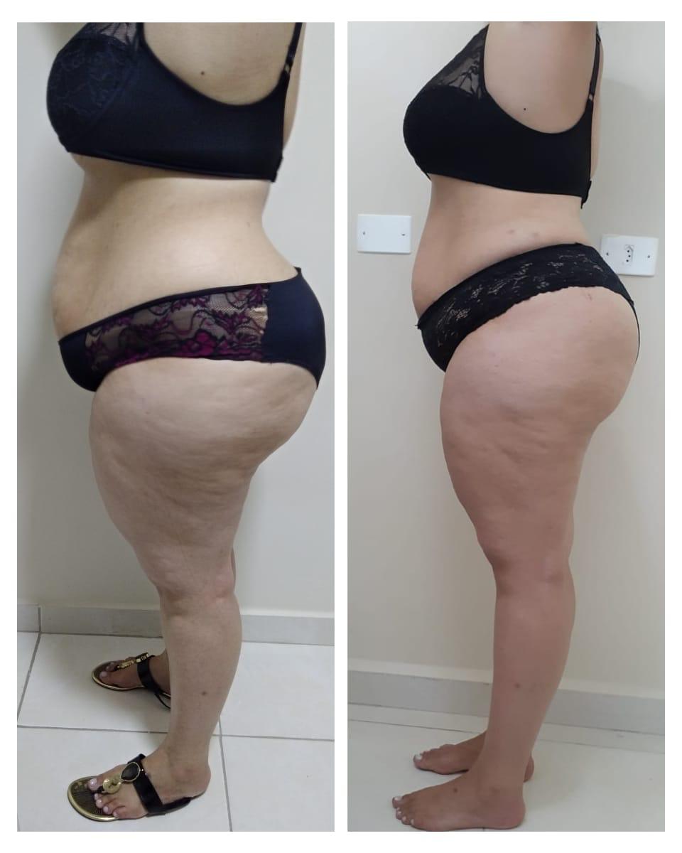 Antes e depois — Redução de gordura localizada